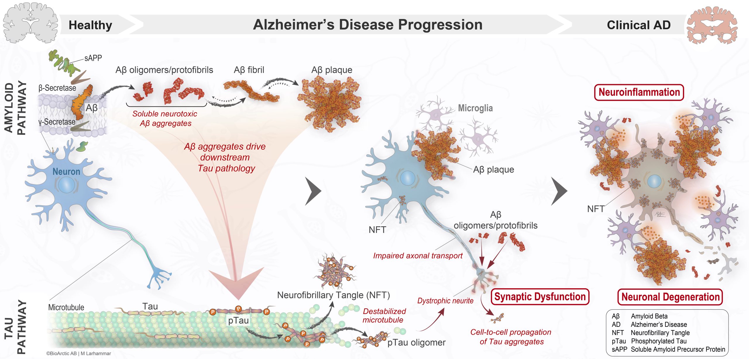 Patologien bak Alzheimers sykdom